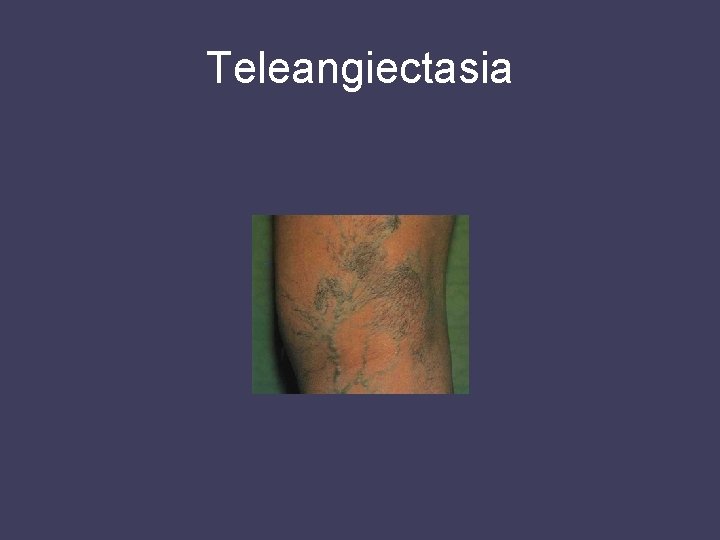 Teleangiectasia 