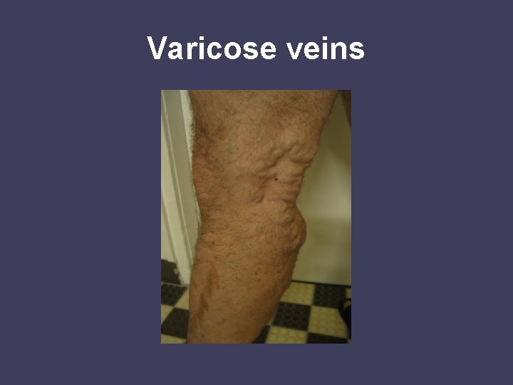 Varicose veins 