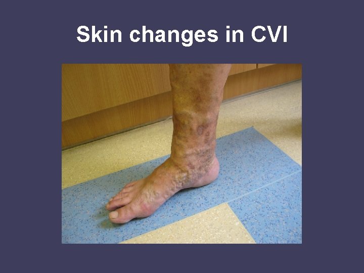 Skin changes in CVI 