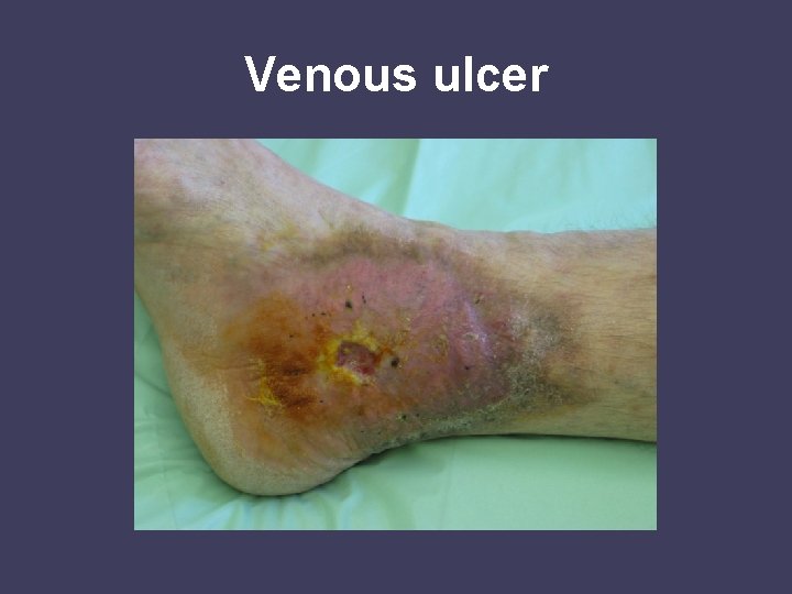 Venous ulcer 