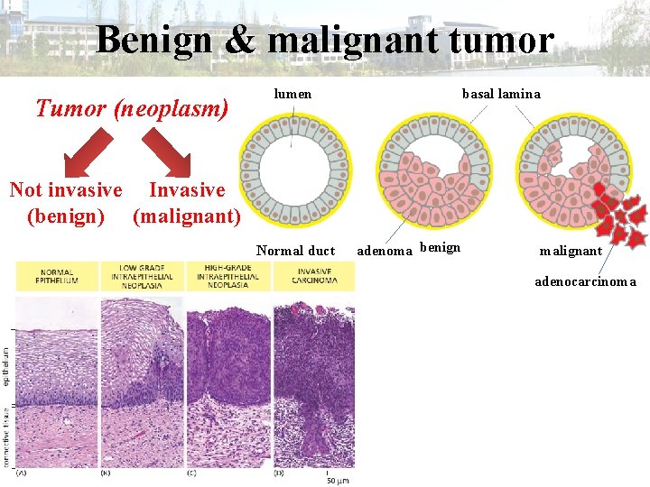 Benign & malignant tumor Tumor (neoplasm) lumen basal lamina Not invasive Invasive (benign) (malignant)