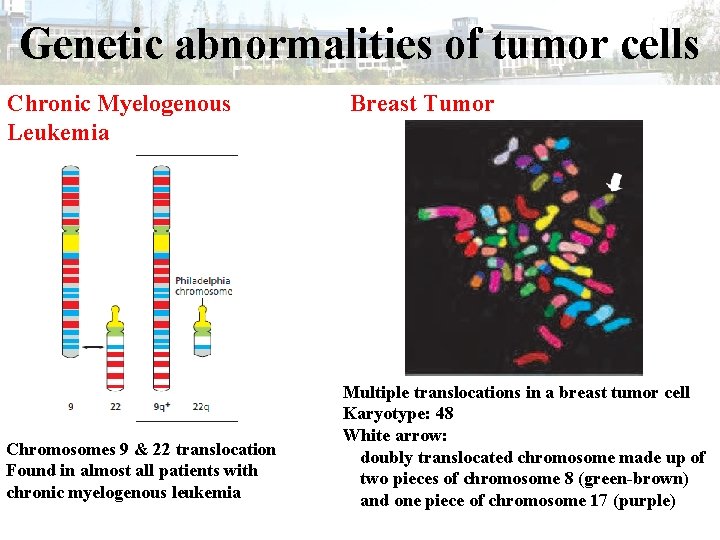 Genetic abnormalities of tumor cells Chronic Myelogenous Leukemia Chromosomes 9 & 22 translocation Found