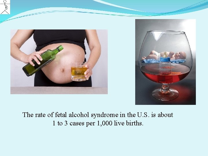 The rate of fetal alcohol syndrome in the U. S. is about 1 to