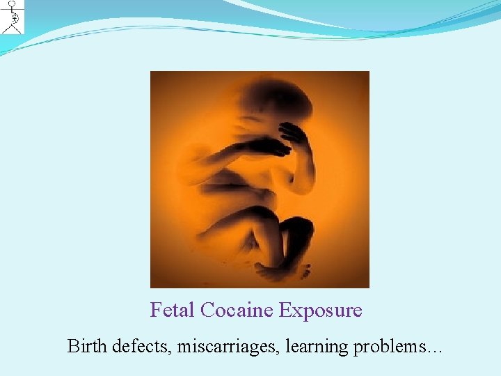Fetal Cocaine Exposure Birth defects, miscarriages, learning problems… 