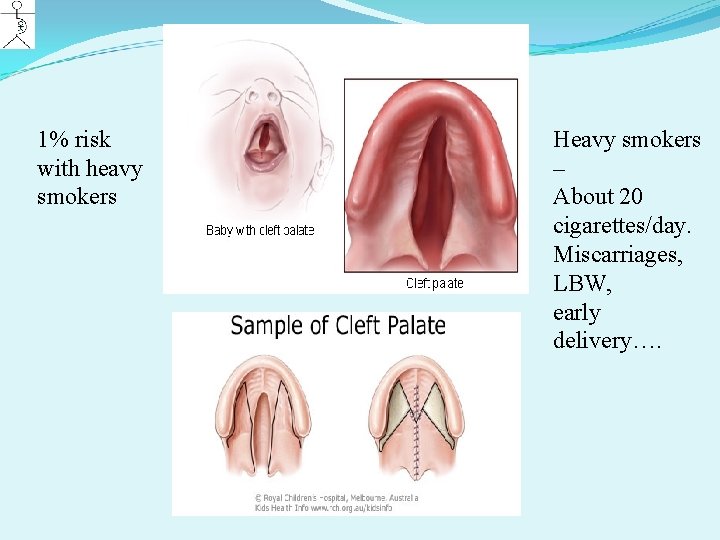 1% risk with heavy smokers Heavy smokers – About 20 cigarettes/day. Miscarriages, LBW, early