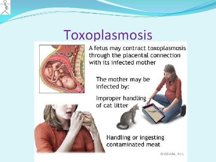 Toxoplasmosis 