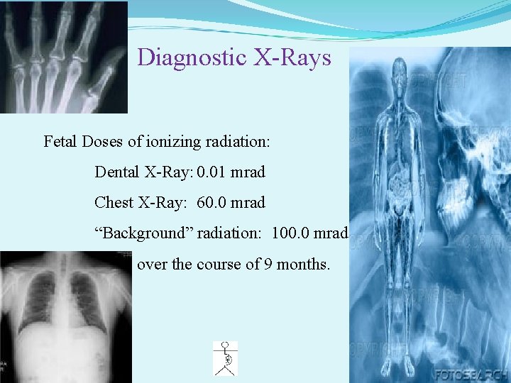 Diagnostic X-Rays Fetal Doses of ionizing radiation: Dental X-Ray: 0. 01 mrad Chest X-Ray:
