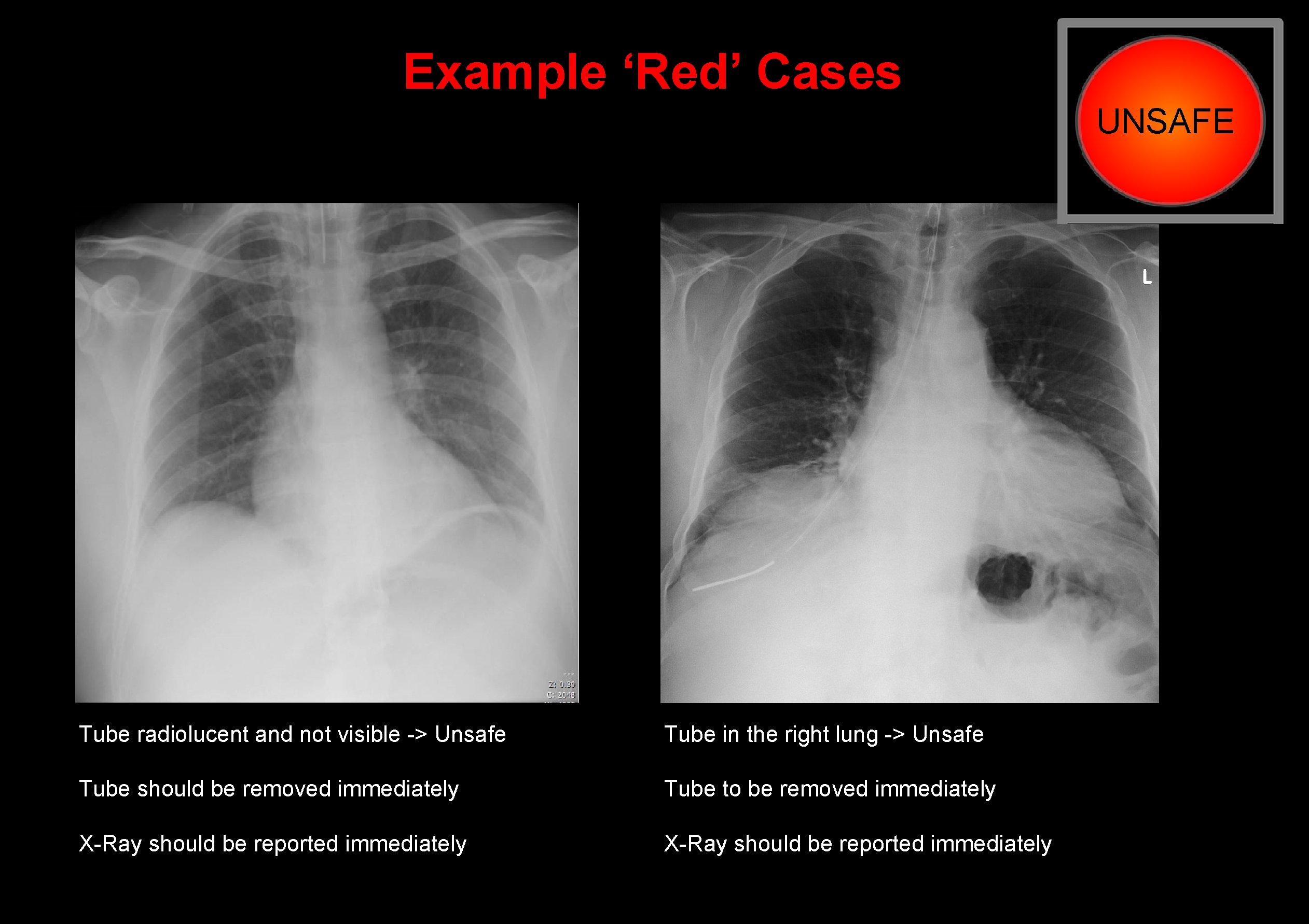 Example ‘Red’ Cases Tube radiolucent and not visible -> Unsafe Tube in the right