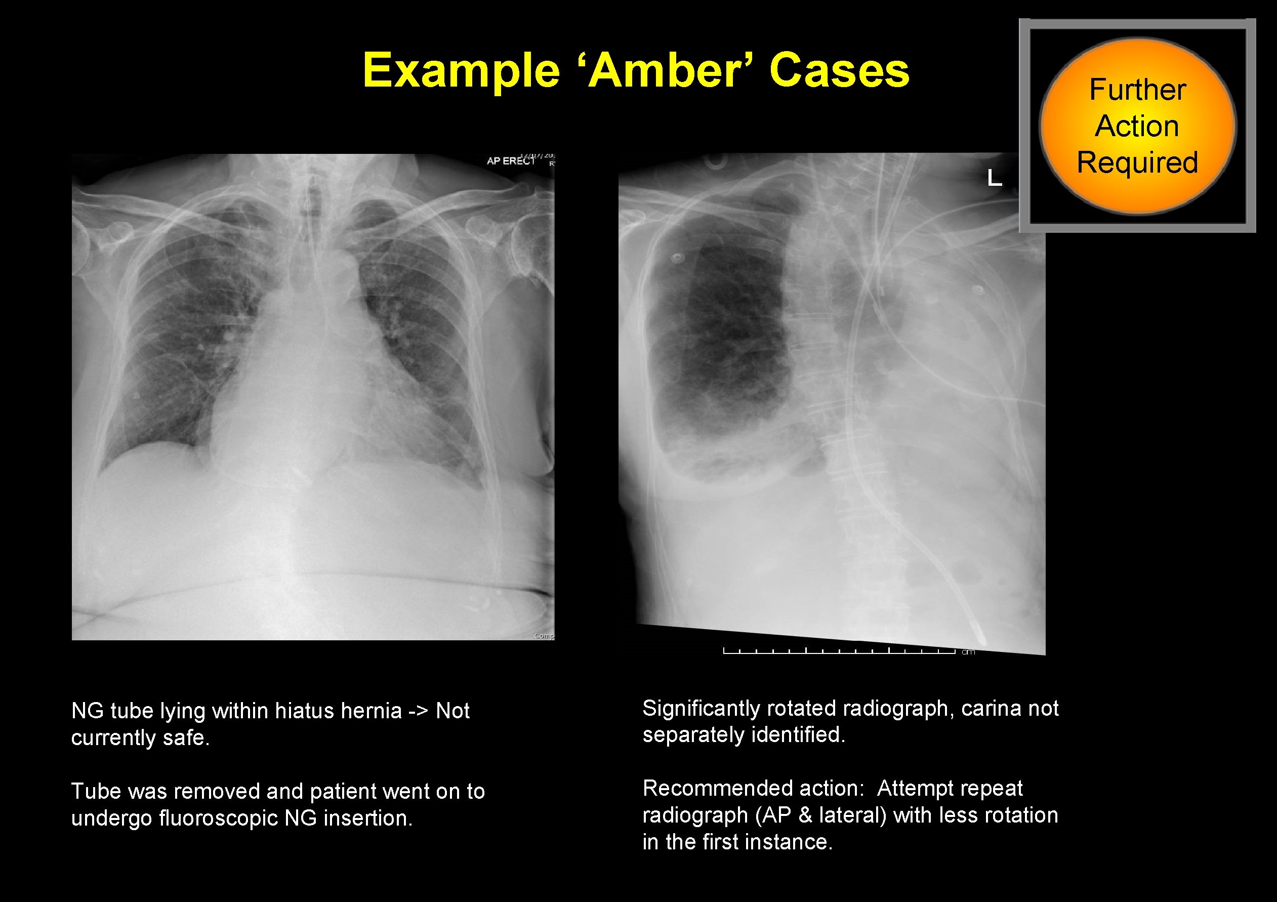 Example ‘Amber’ Cases NG tube lying within hiatus hernia -> Not currently safe. Significantly