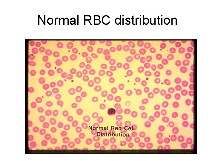 Normal RBC distribution 