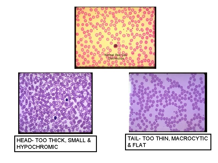 HEAD- TOO THICK, SMALL & HYPOCHROMIC TAIL- TOO THIN, MACROCYTIC & FLAT 