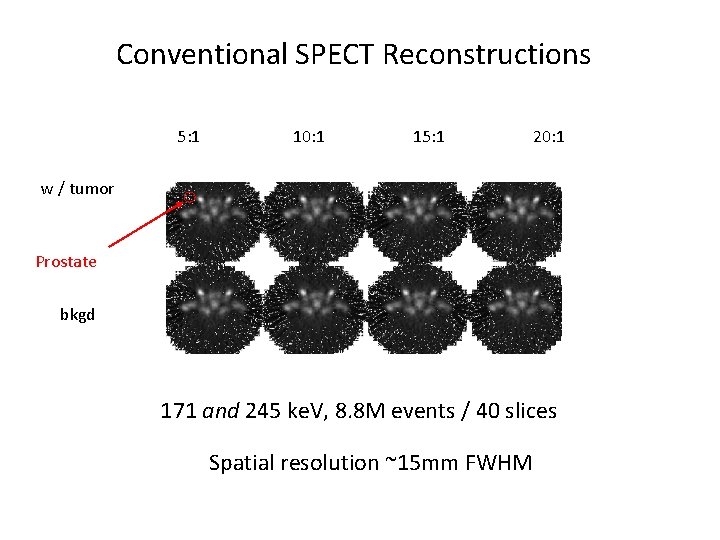 Conventional SPECT Reconstructions 5: 1 10: 1 15: 1 20: 1 w / tumor