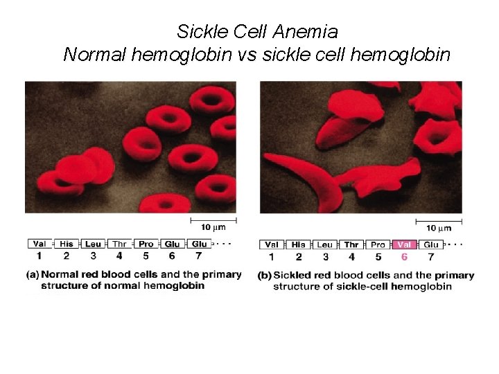 Sickle Cell Anemia Normal hemoglobin vs sickle cell hemoglobin 