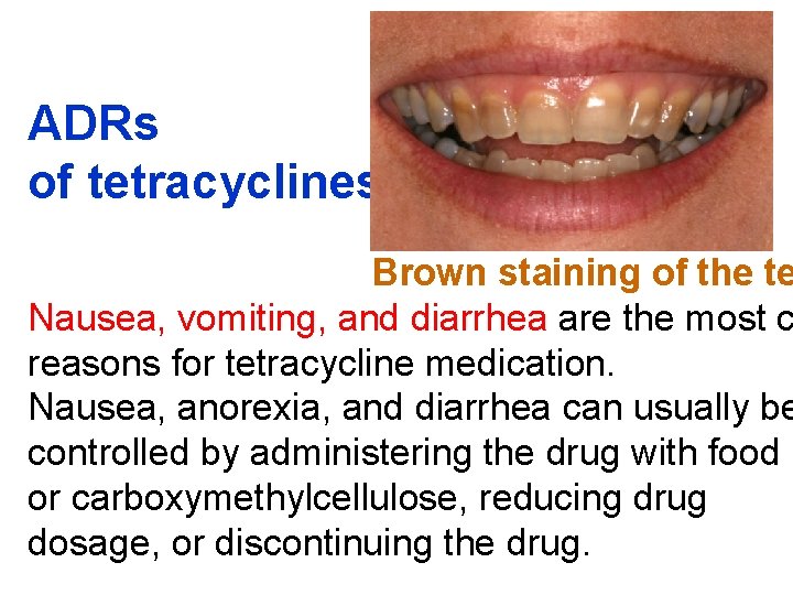 ADRs of tetracyclines Brown staining of the te Nausea, vomiting, and diarrhea are the