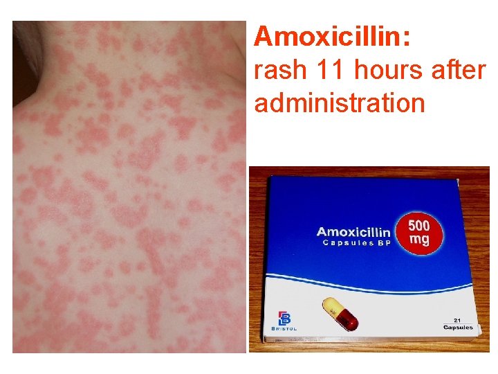 Amoxicillin: rash 11 hours after administration 