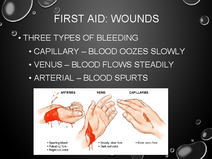 FIRST AID: WOUNDS • THREE TYPES OF BLEEDING • CAPILLARY – BLOOD OOZES SLOWLY