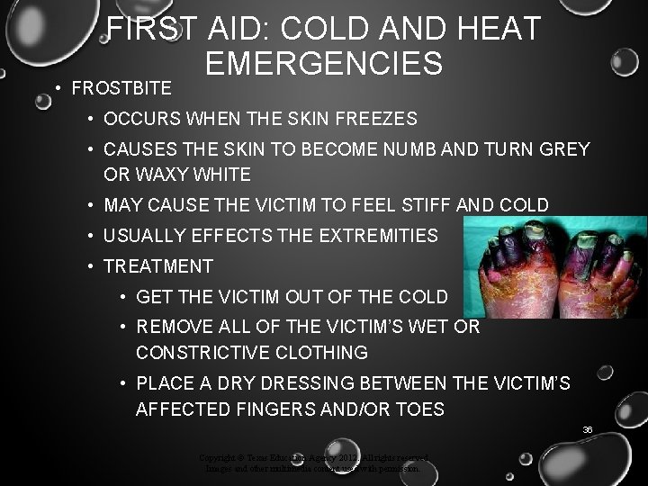 FIRST AID: COLD AND HEAT EMERGENCIES • FROSTBITE • OCCURS WHEN THE SKIN FREEZES