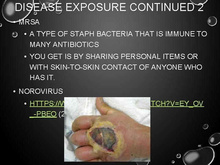 DISEASE EXPOSURE CONTINUED 2 • MRSA • A TYPE OF STAPH BACTERIA THAT IS