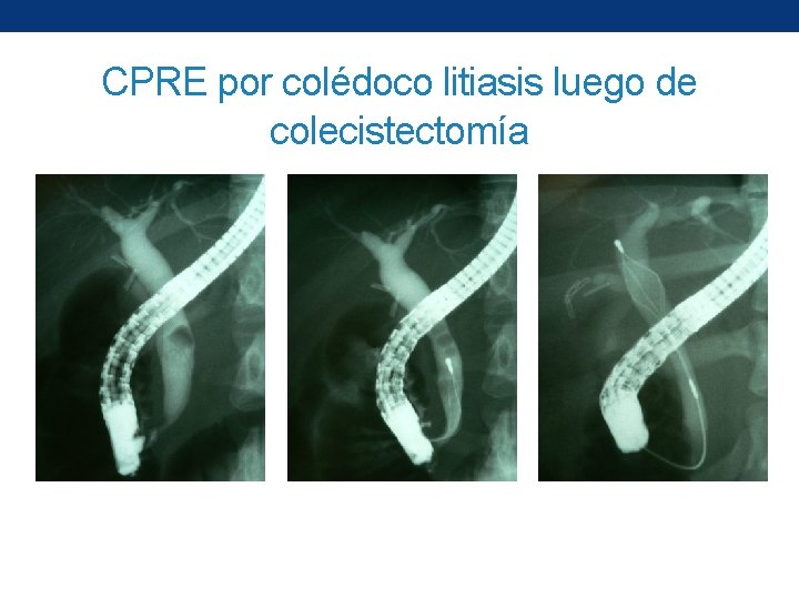 CPRE por colédoco litiasis luego de colecistectomía 