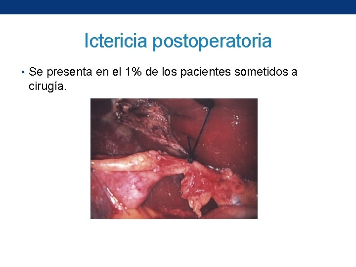 Ictericia postoperatoria • Se presenta en el 1% de los pacientes sometidos a cirugía.