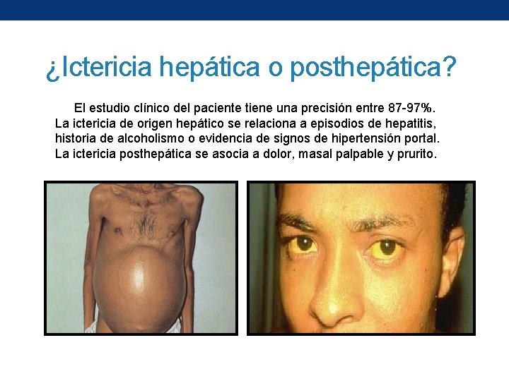 ¿Ictericia hepática o posthepática? El estudio clínico del paciente tiene una precisión entre 87