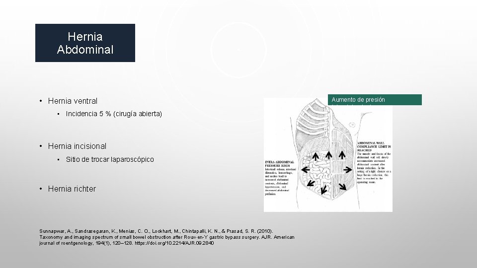 Hernia Abdominal • Hernia ventral • Incidencia 5 % (cirugía abierta) • Hernia incisional