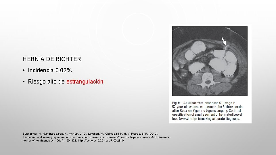 HERNIA DE RICHTER • Incidencia 0. 02% • Riesgo alto de estrangulación Sunnapwar, A.