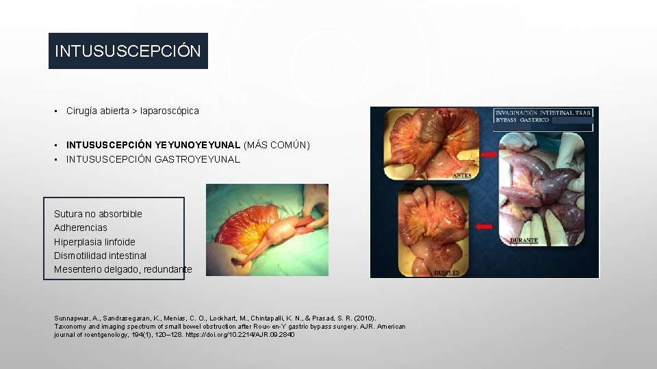 INTUSUSCEPCIÓN • Cirugía abierta > laparoscópica • INTUSUSCEPCIÓN YEYUNOYEYUNAL (MÁS COMÚN) • INTUSUSCEPCIÓN GASTROYEYUNAL