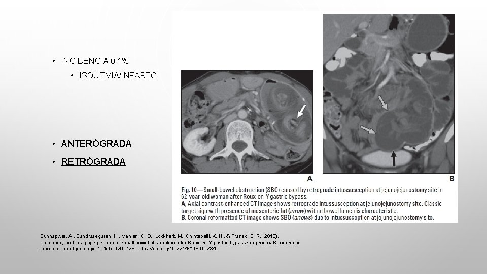  • INCIDENCIA 0. 1% • ISQUEMIA/INFARTO • ANTERÓGRADA • RETRÓGRADA Sunnapwar, A. ,