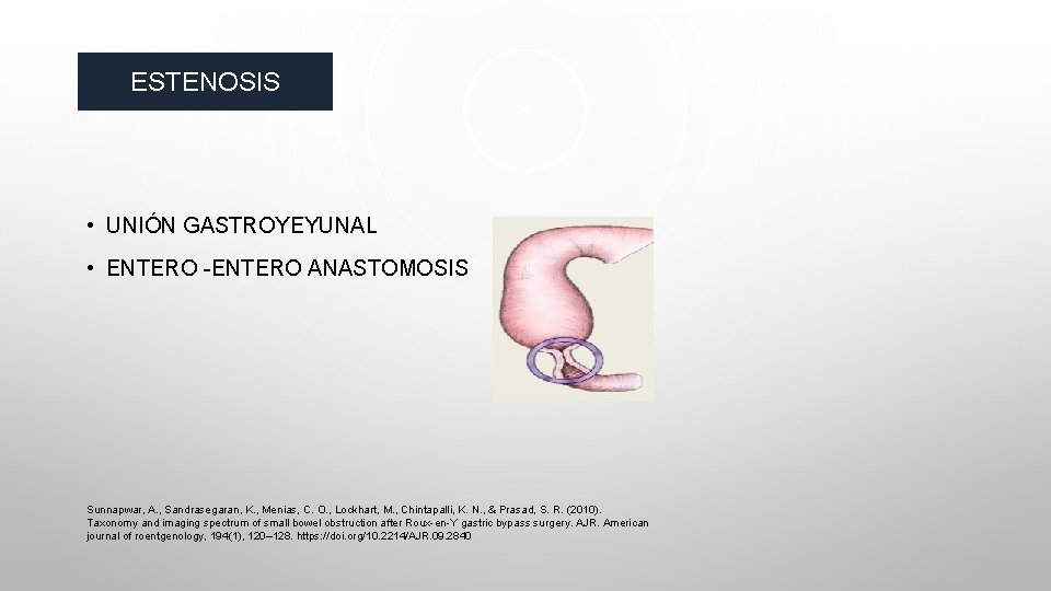 ESTENOSIS • UNIÓN GASTROYEYUNAL • ENTERO -ENTERO ANASTOMOSIS Sunnapwar, A. , Sandrasegaran, K. ,