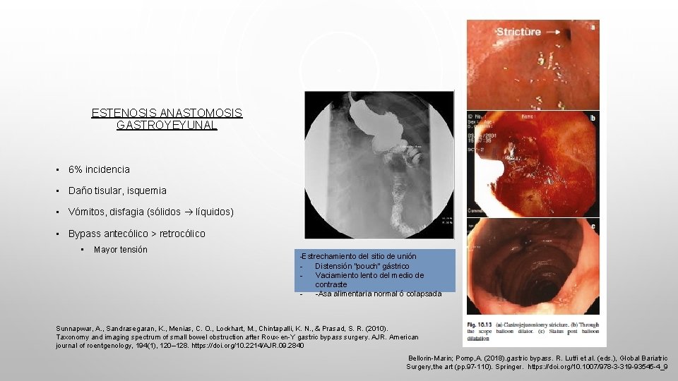 ESTENOSIS ANASTOMOSIS GASTROYEYUNAL • 6% incidencia • Daño tisular, isquemia • Vómitos, disfagia (sólidos