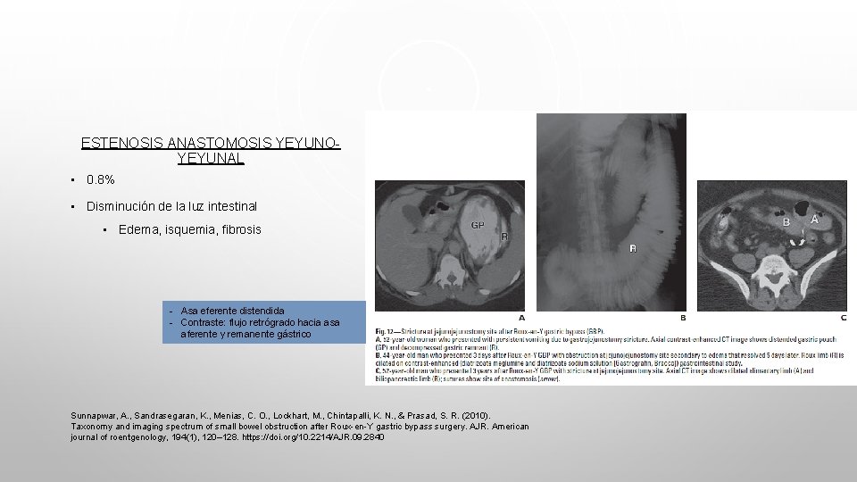 ESTENOSIS ANASTOMOSIS YEYUNOYEYUNAL • 0. 8% • Disminución de la luz intestinal • Edema,