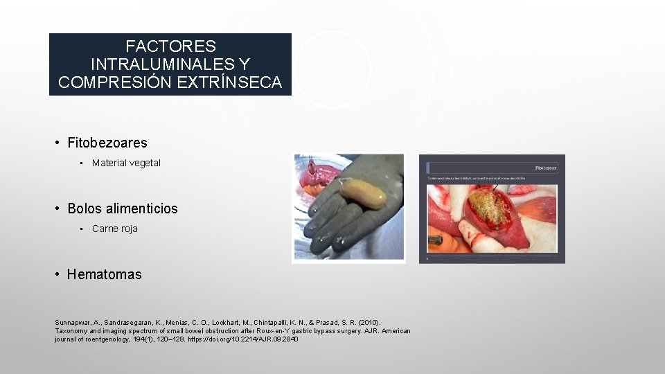 FACTORES INTRALUMINALES Y COMPRESIÓN EXTRÍNSECA • Fitobezoares • Material vegetal • Bolos alimenticios •