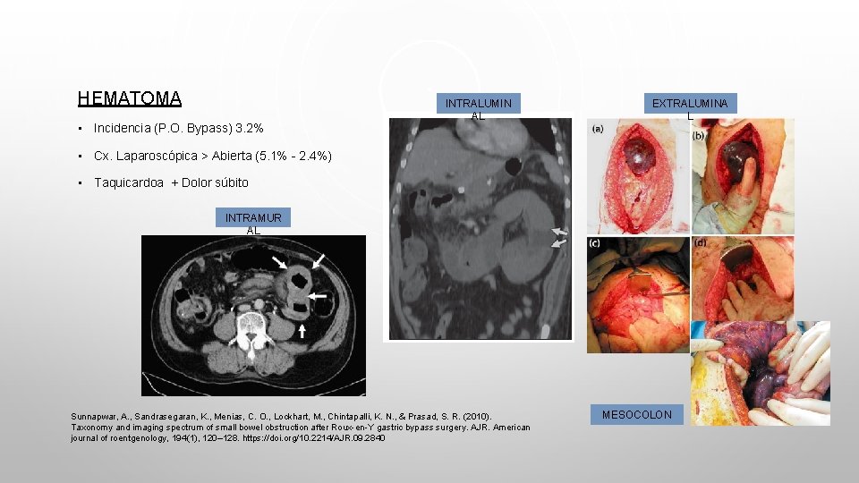 HEMATOMA • Incidencia (P. O. Bypass) 3. 2% INTRALUMIN AL EXTRALUMINA L • Cx.