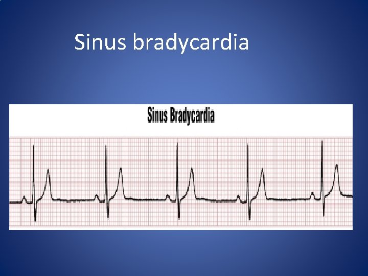 Sinus bradycardia 