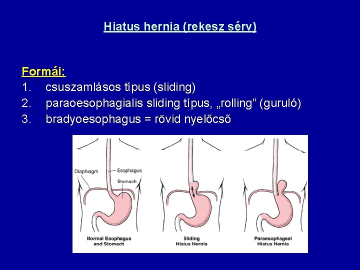 Hiatus hernia (rekesz sérv) Formái: 1. csuszamlásos típus (sliding) 2. paraoesophagialis sliding típus, „rolling”