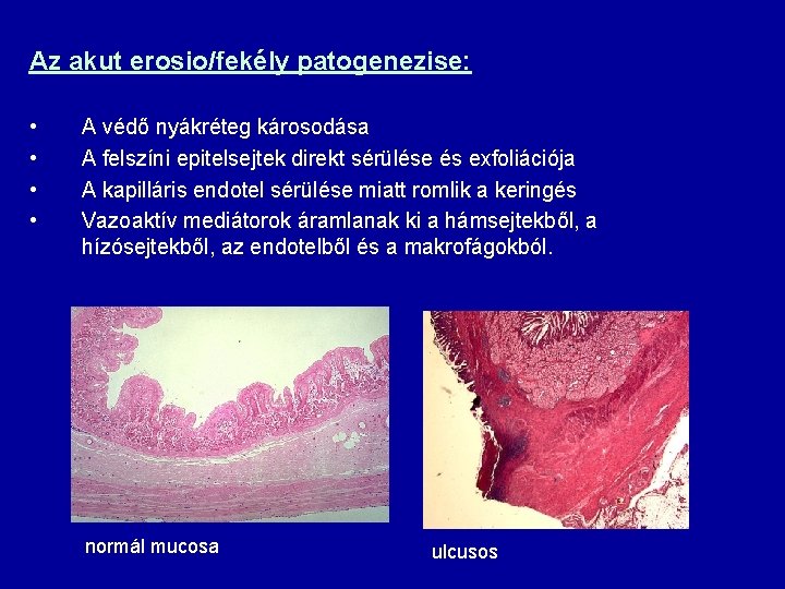 Az akut erosio/fekély patogenezise: • • A védő nyákréteg károsodása A felszíni epitelsejtek direkt