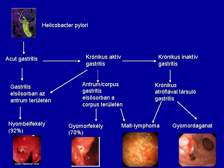 Helicobacter pylori Acut gastritis Gastritis elsősorban az antrum területén Nyombélfekély (92%) Krónikus aktív gastritis