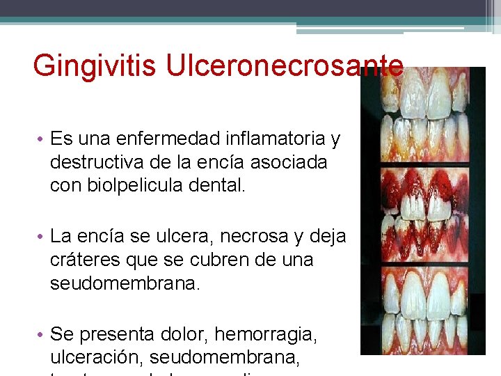 Gingivitis Ulceronecrosante • Es una enfermedad inflamatoria y destructiva de la encía asociada con