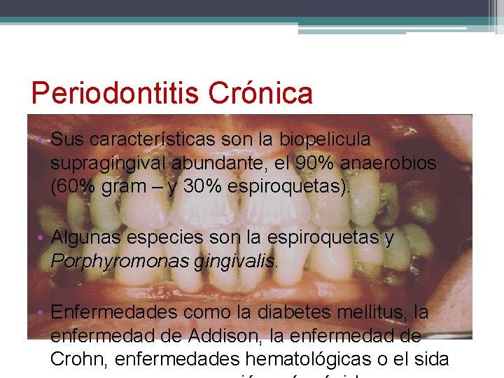 Periodontitis Crónica • Sus características son la biopelicula supragingival abundante, el 90% anaerobios (60%