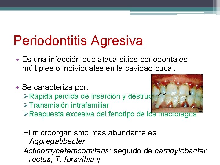 Periodontitis Agresiva • Es una infección que ataca sitios periodontales múltiples o individuales en
