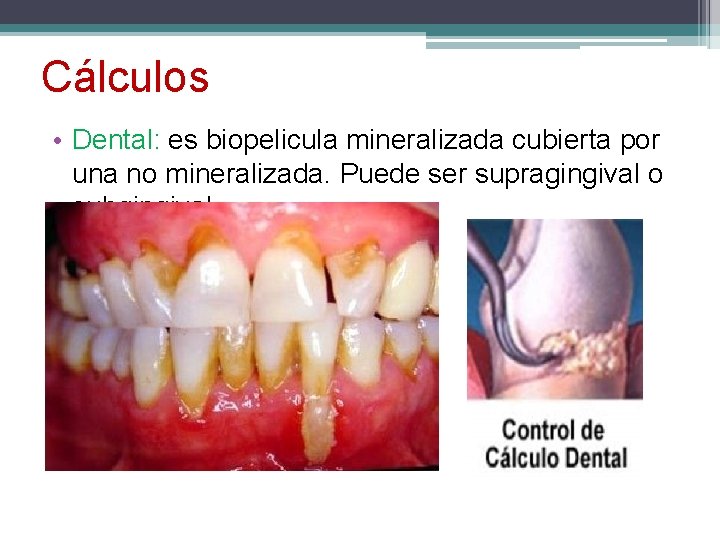 Cálculos • Dental: es biopelicula mineralizada cubierta por una no mineralizada. Puede ser supragingival