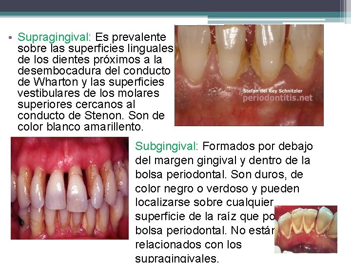  • Supragingival: Es prevalente sobre las superficies linguales de los dientes próximos a