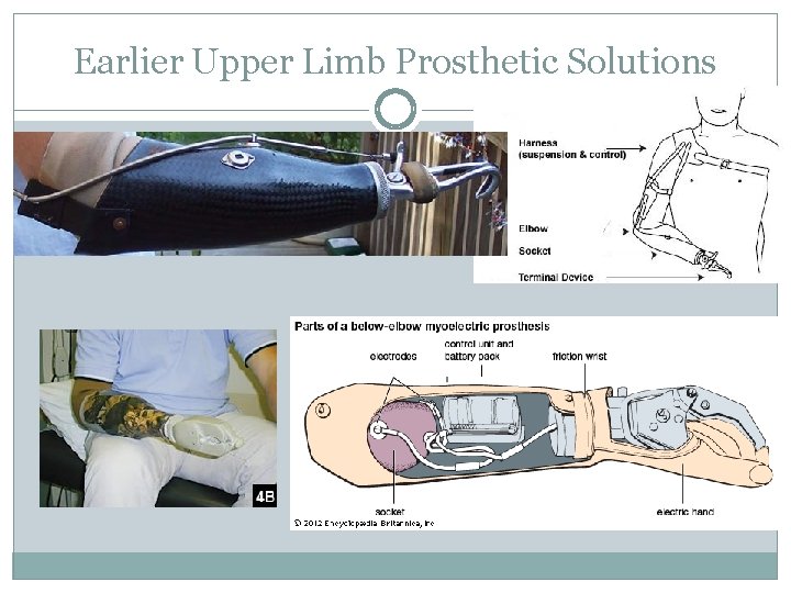 Earlier Upper Limb Prosthetic Solutions 