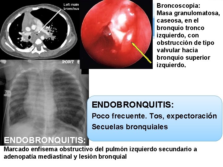 Broncoscopia: Masa granulomatosa, caseosa, en el bronquio tronco izquierdo, con obstrucción de tipo valvular