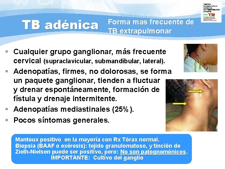 TB adénica Forma mas frecuente de TB extrapulmonar § Cualquier grupo ganglionar, más frecuente