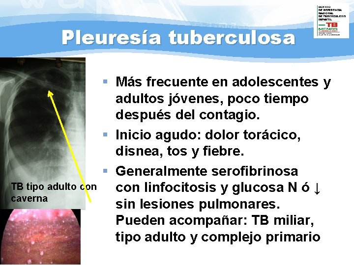 Pleuresía tuberculosa TB tipo adulto con caverna § Más frecuente en adolescentes y adultos