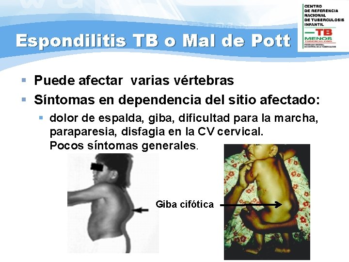 Espondilitis TB o Mal de Pott § Puede afectar varias vértebras § Síntomas en