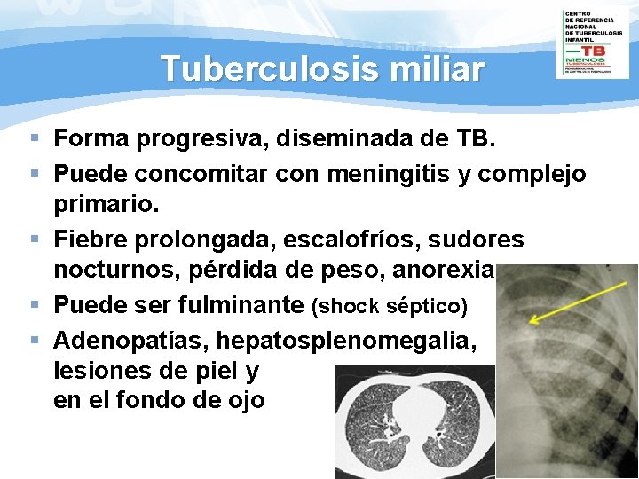 Tuberculosis miliar § Forma progresiva, diseminada de TB. § Puede concomitar con meningitis y