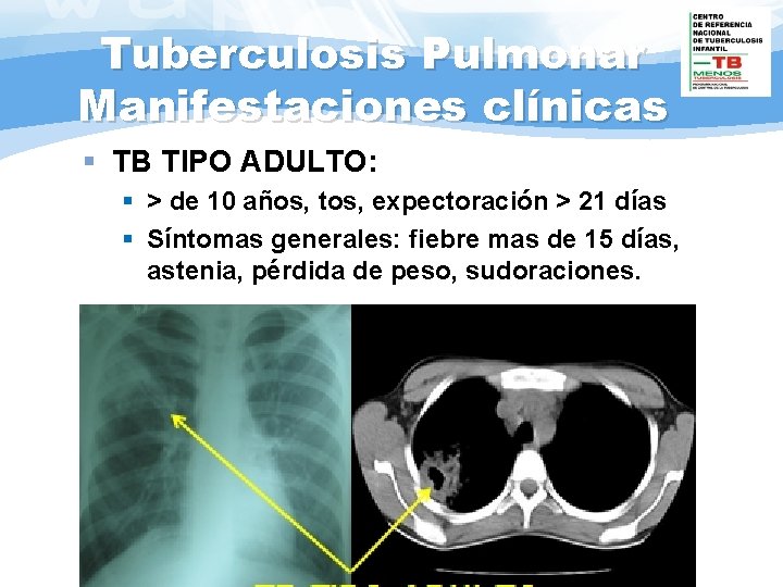 Tuberculosis Pulmonar Manifestaciones clínicas § TB TIPO ADULTO: § > de 10 años, tos,